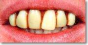 Billy Bob Teeth decay dentist rotting rotten